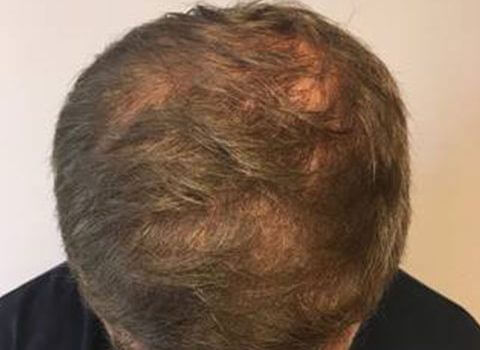 Hair Transplant Michigan - Michigan Hair Restoration - Dr. Berkowitz