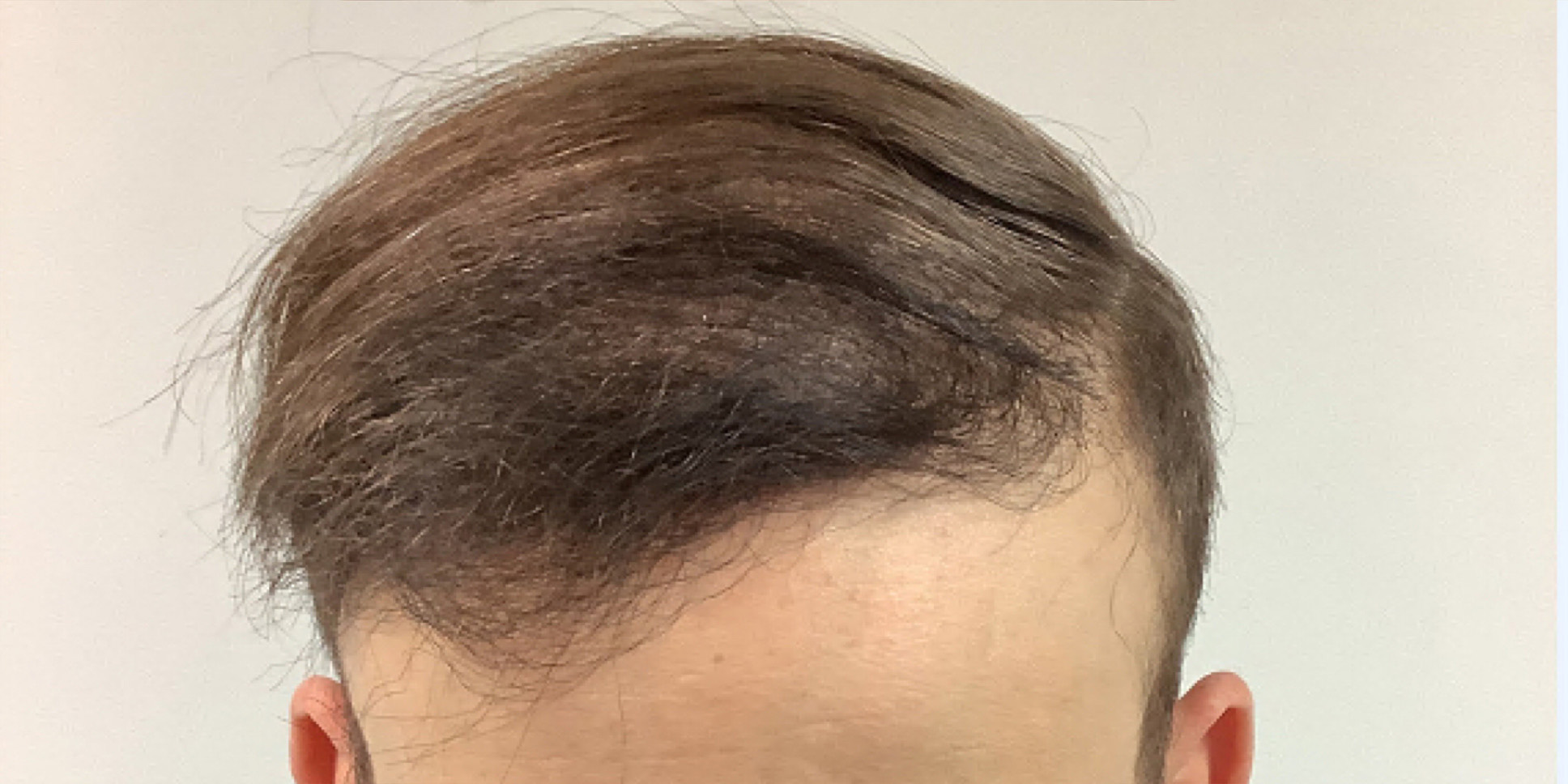 NeoGraft Hair Restoration Michigan
