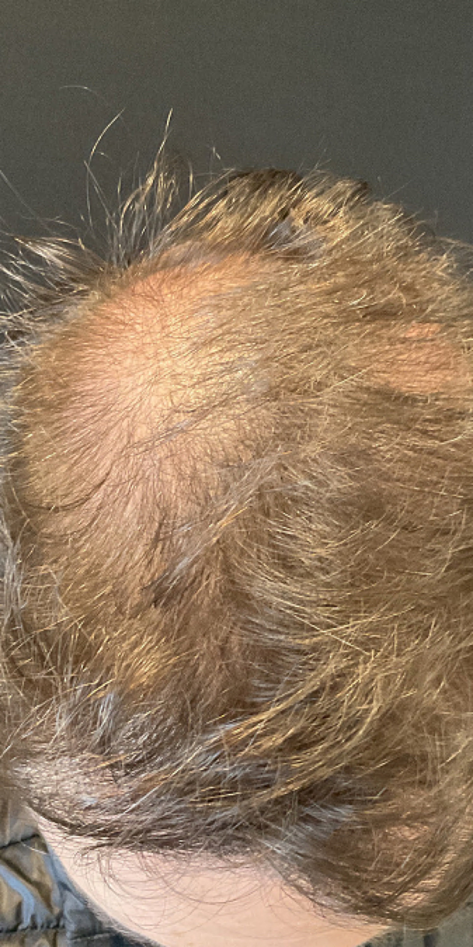 For Men Before and After | Michigan Hair Restoration