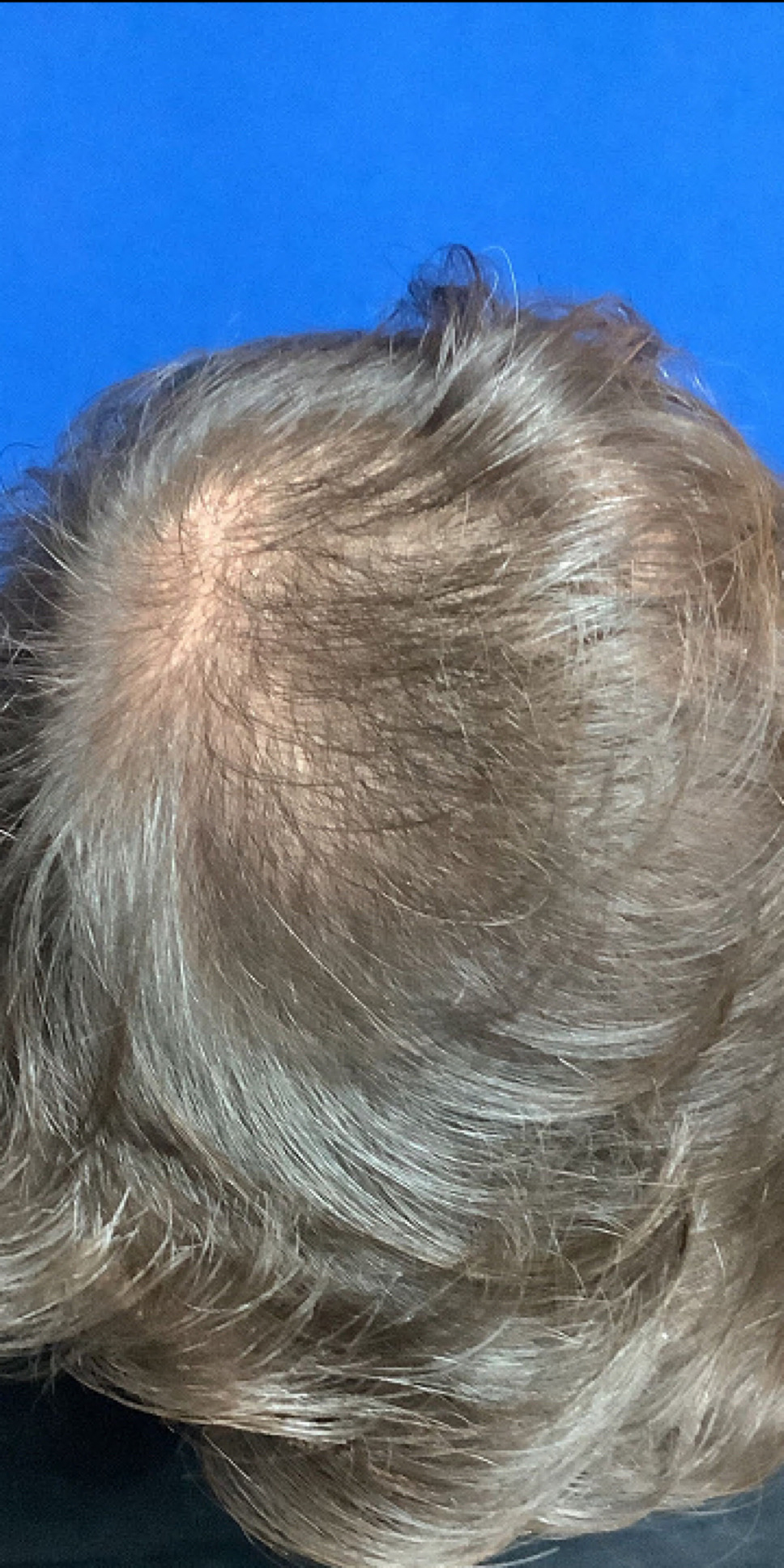 For Men Before and After | Michigan Hair Restoration