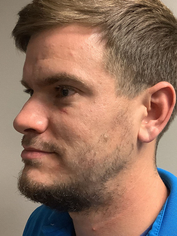 For Men Before and After | Michigan Hair Restoration