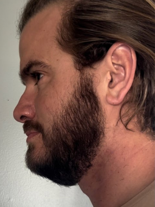 For Men Before and After | Michigan Hair Restoration