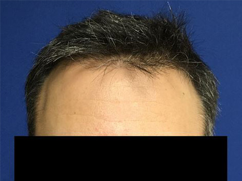 For Men Before and After | Michigan Hair Restoration