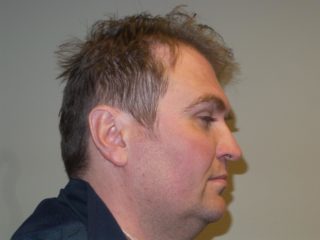 For Men Before and After | Michigan Hair Restoration