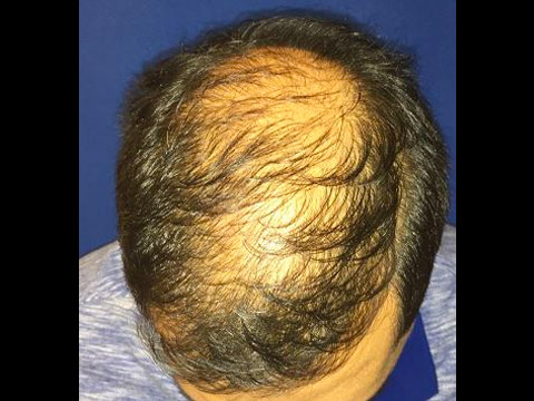 For Men Before and After | Michigan Hair Restoration