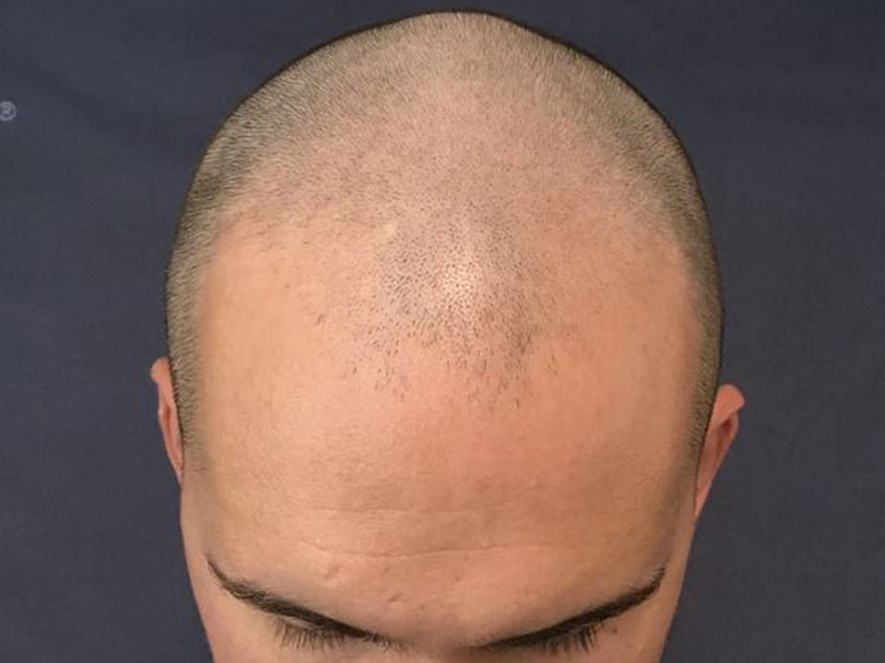 For Men Before and After | Michigan Hair Restoration