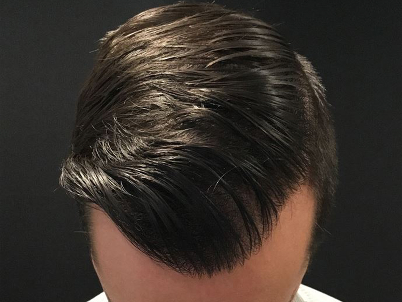 For Men Before and After | Michigan Hair Restoration
