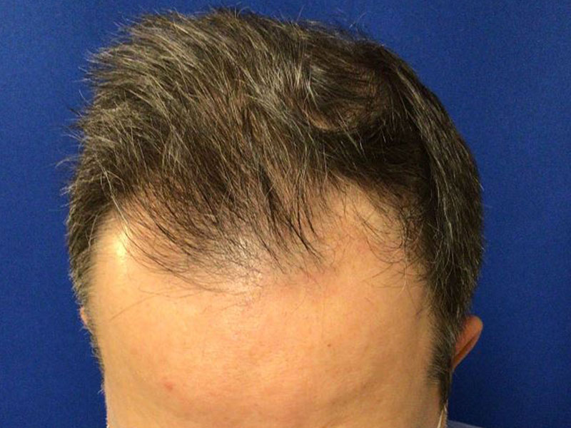 For Men Before and After | Michigan Hair Restoration