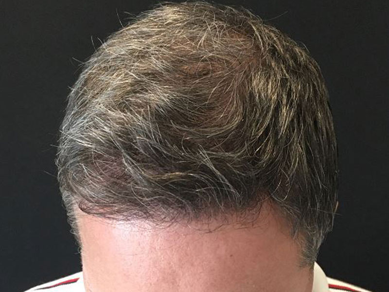 For Men Before and After | Michigan Hair Restoration