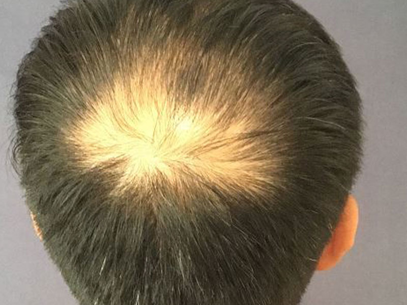 For Men Before and After | Michigan Hair Restoration