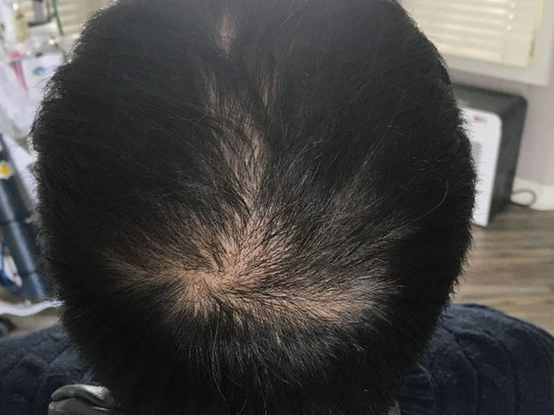 For Men Before and After | Michigan Hair Restoration