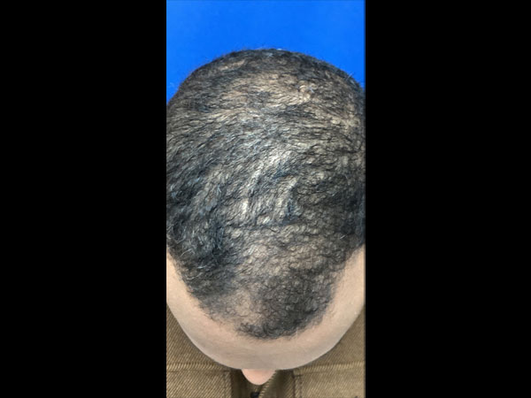 For Men Before and After | Michigan Hair Restoration