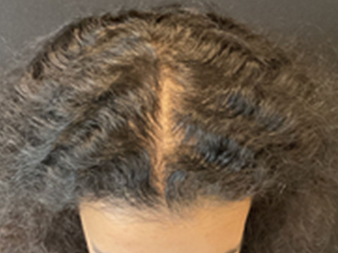 Hair Restoration for Women