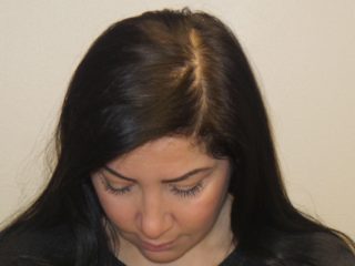 Hair Restoration for Women
