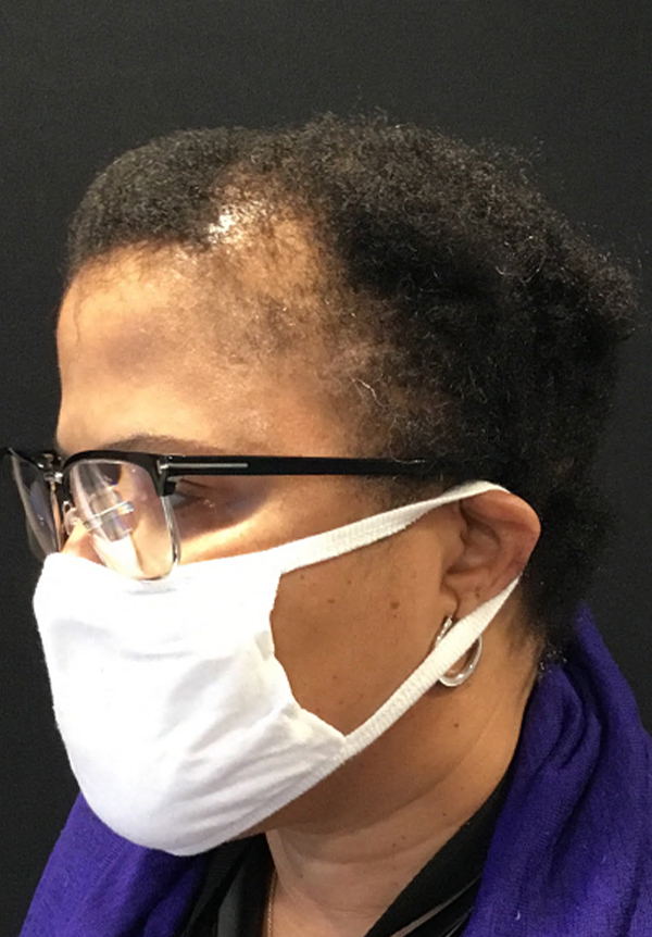 For Women Before and After | Michigan Hair Restoration