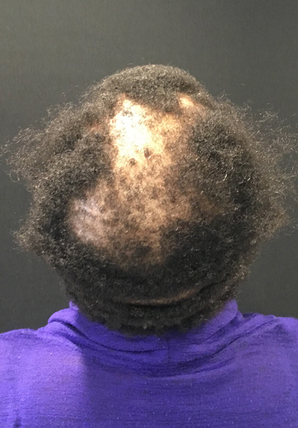 For Women Before and After | Michigan Hair Restoration