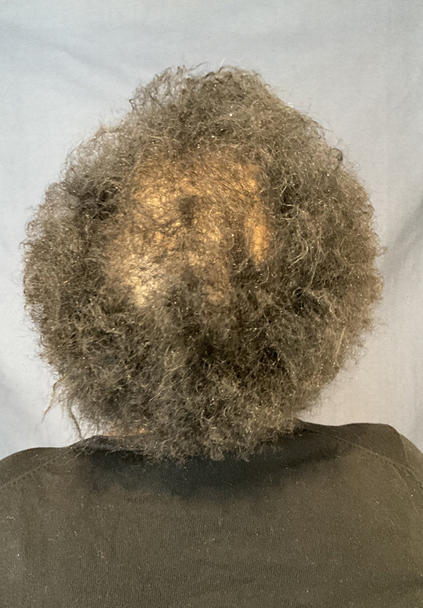 For Women Before and After | Michigan Hair Restoration