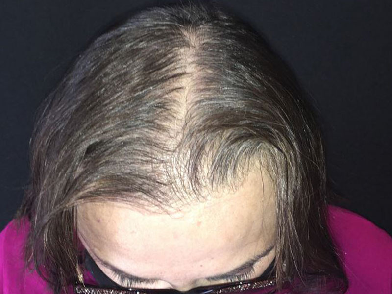 For Women Before and After | Michigan Hair Restoration