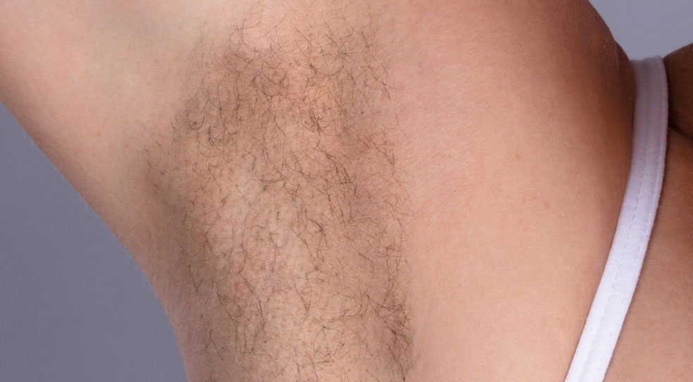 Laser Hair Removal Before and After | Michigan Hair Restoration